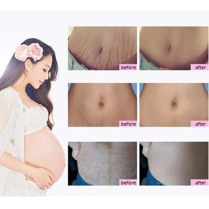 Rtopr Stretch Mark Cream for Pregnancy Repair Scar Slack Line Abdomen Stretch Marks Cream, Remove Stretch Marks from Pregnancy, Repair Scar Slack Line Abdomen Stretch Marks Postpartum