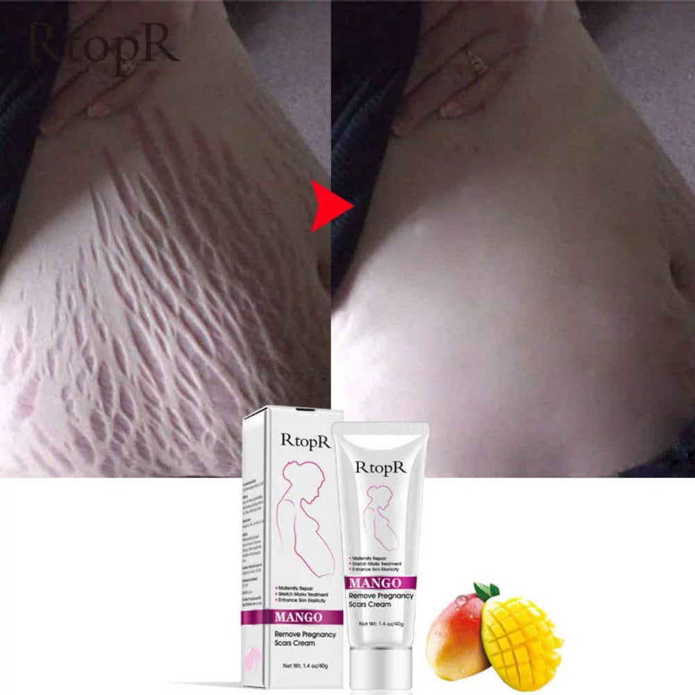 Rtopr Stretch Mark Cream for Pregnancy Repair Scar Slack Line Abdomen Stretch Marks Cream, Remove Stretch Marks from Pregnancy, Repair Scar Slack Line Abdomen Stretch Marks Postpartum